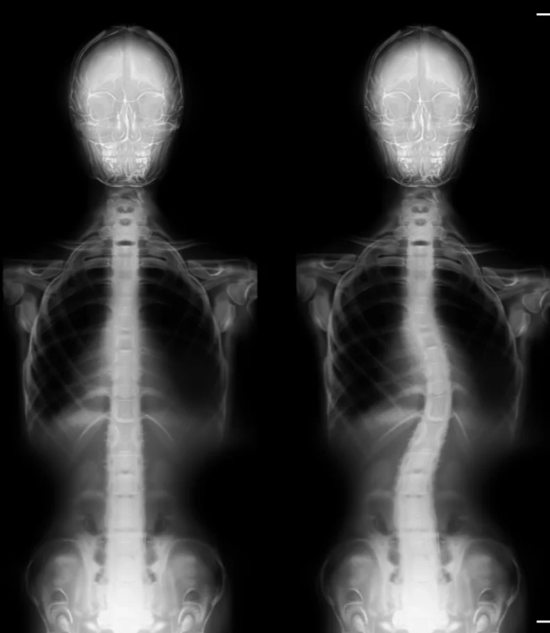 Scoliosis Durango